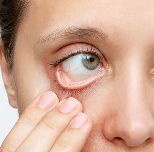 Anaemia Profile Dubai