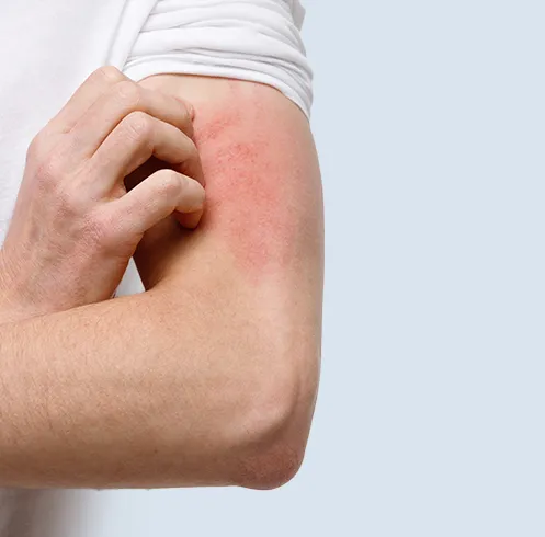 Psoriasis Investigation Dubai