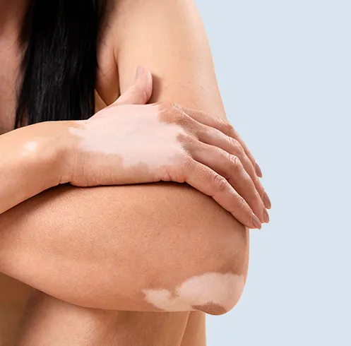 Vitiligo Test Dubai icon 1